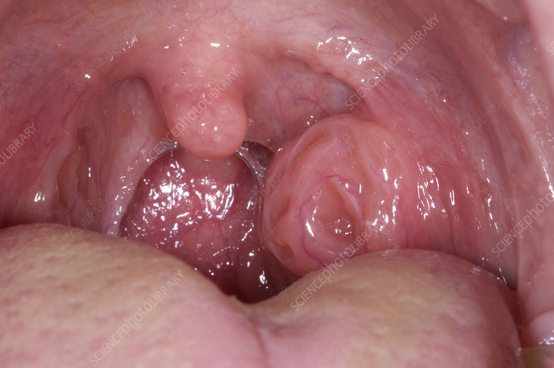 Bademcik Ameliyatı Tonsillektomi