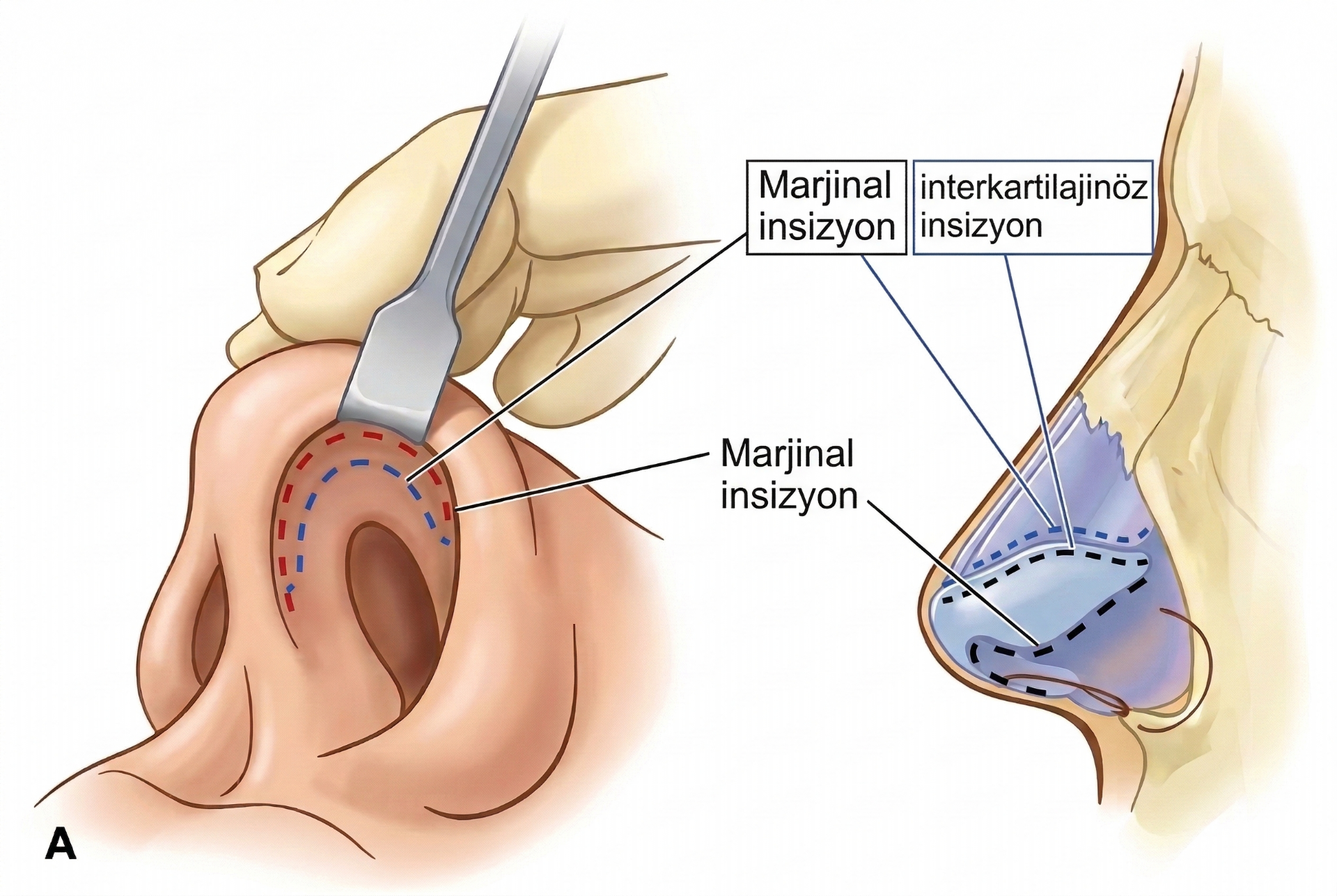 Kapalı Rinoplasti Closed Rhinoplasty