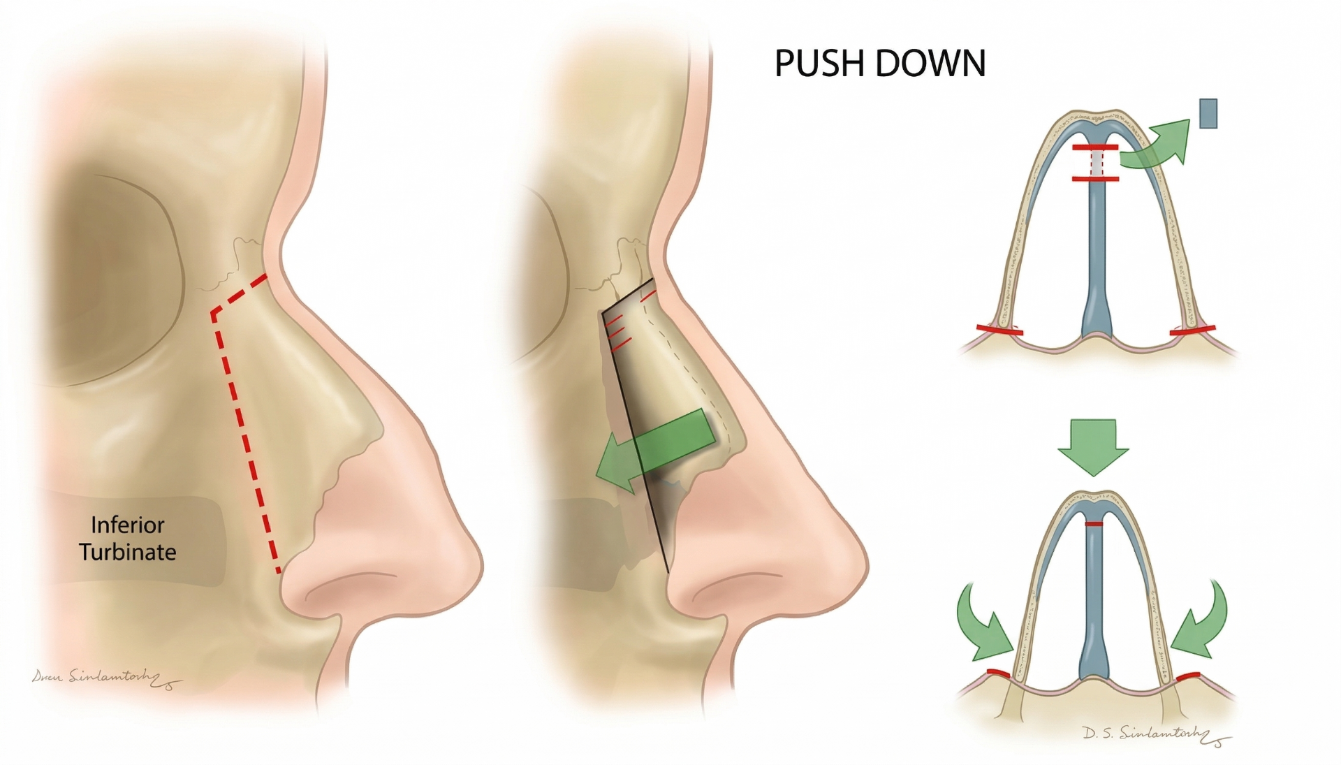 Push-Down Rinoplasti