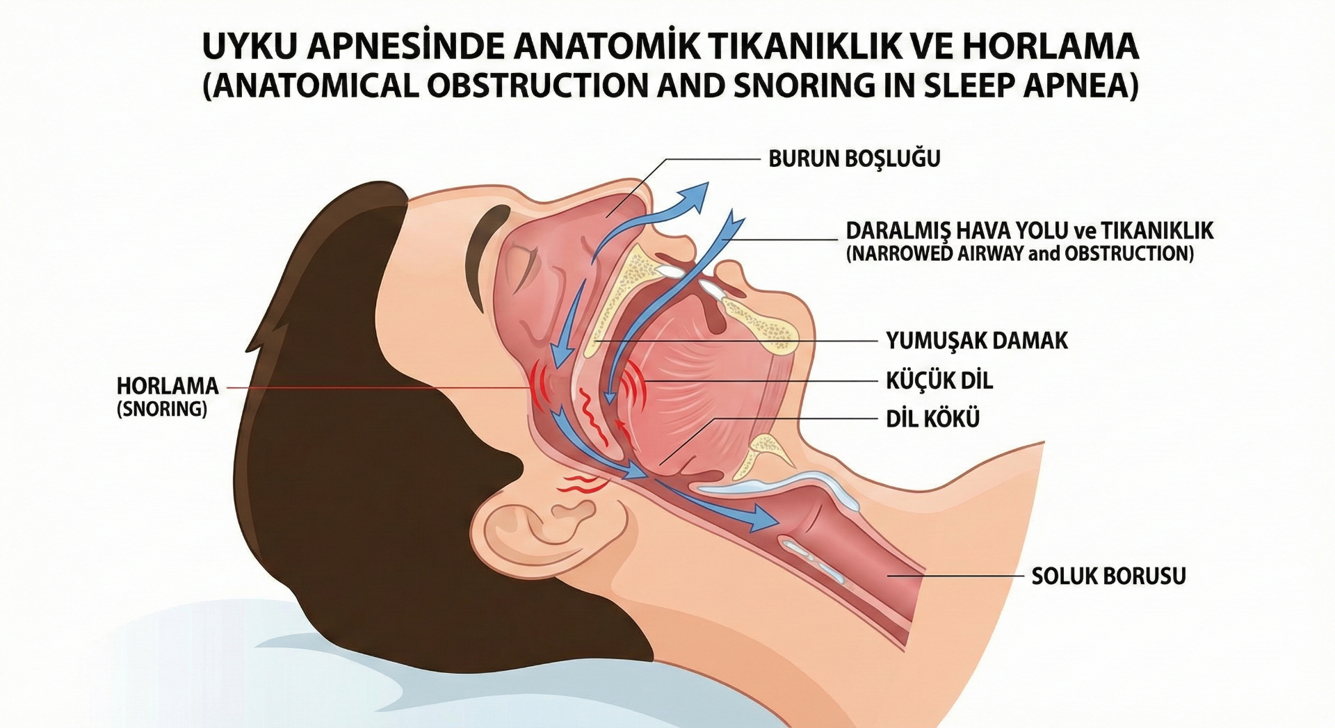 Uyku Apnesi ve Horlama Cerrahisi